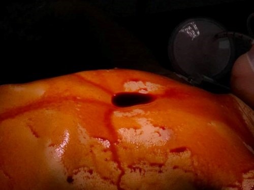 Hình ảnh lồng ngực bị lõm sâu của bệnh nhi. Ảnh: BVCC