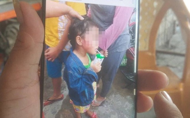 Bé gái 5 tuổi bị thương tích do cô giáo bạo hành. 
