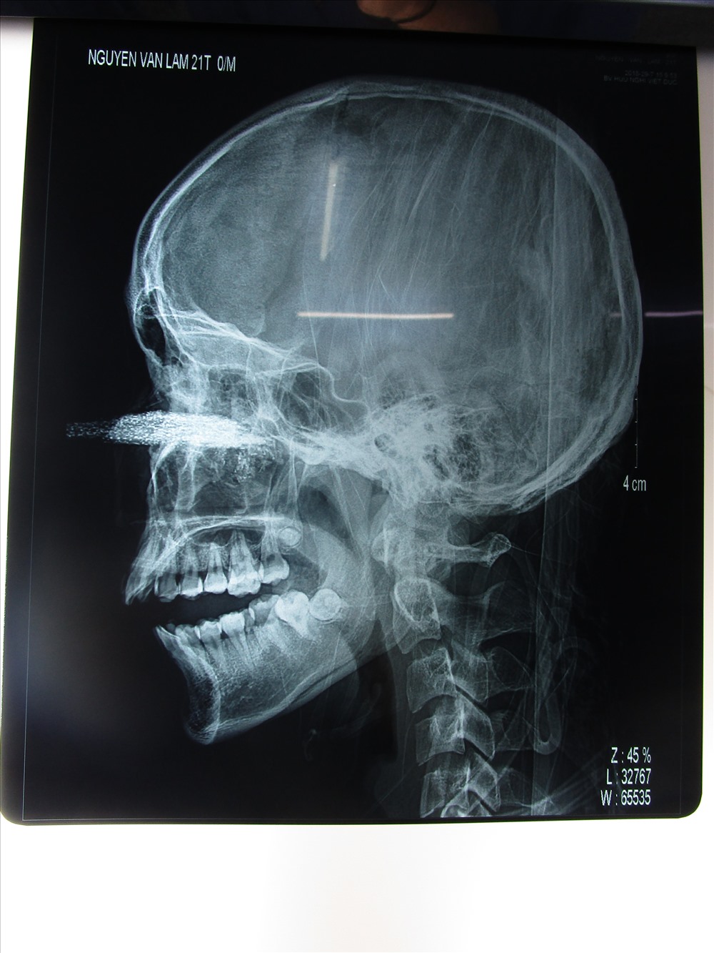 Hình chụp Xquang cho thấy lưỡi cưa găm sâu vào mặt. Ảnh: BSCC