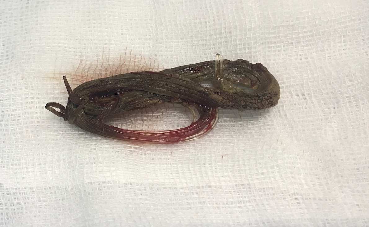 Sợi dây cước có kích thước khoảng 2,5cmx6cm phát hiện trong niệu đạo bệnh nhân