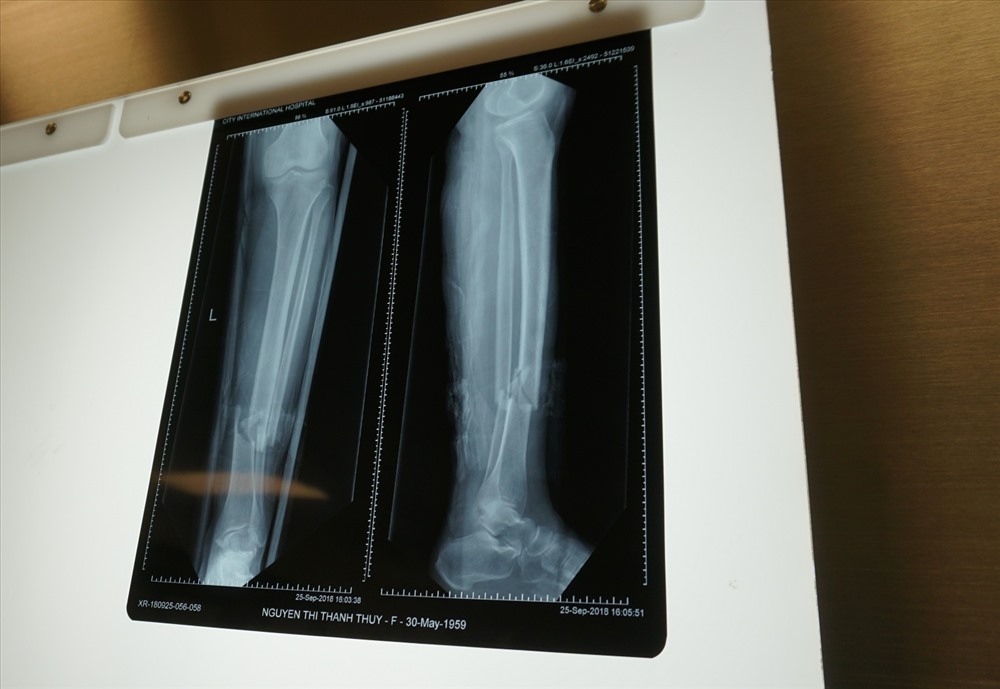 Bệnh nhân bị gãy hở 1/3 dưới hai xương cẳng chân do tai nạn giao thông