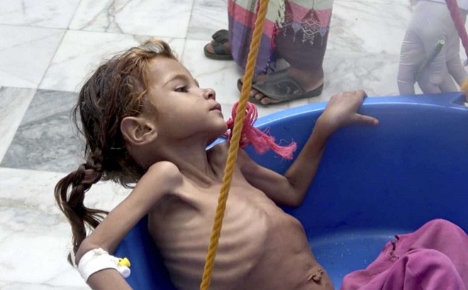 Trẻ em Yemen bị suy dinh dưỡng nghiêm trọng