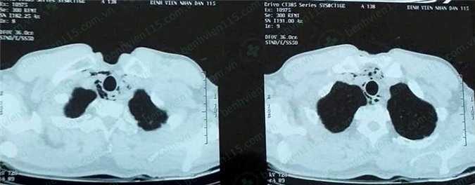 Hình ảnh CT scan ngực không cản quang của bệnh nhân. Ảnh: BVCC.