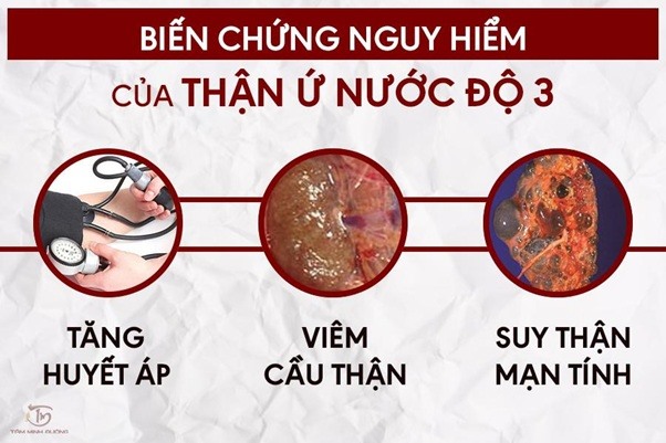 Ung Thư Thận Tế Bào Sáng: Những Điều Cần Biết và Hướng Điều Trị Hiệu Quả