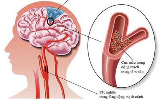 Tai biến mạch máu não có thể gây ra nhiều biến chứng nguy hiểm.