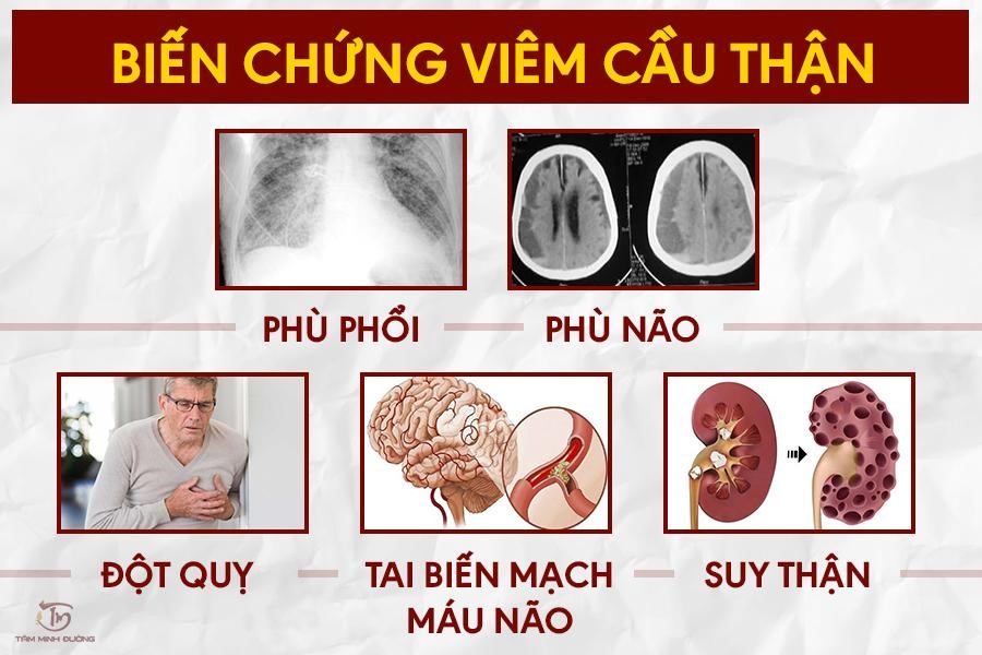 Phương pháp chẩn đoán bệnh viêm cầu thận