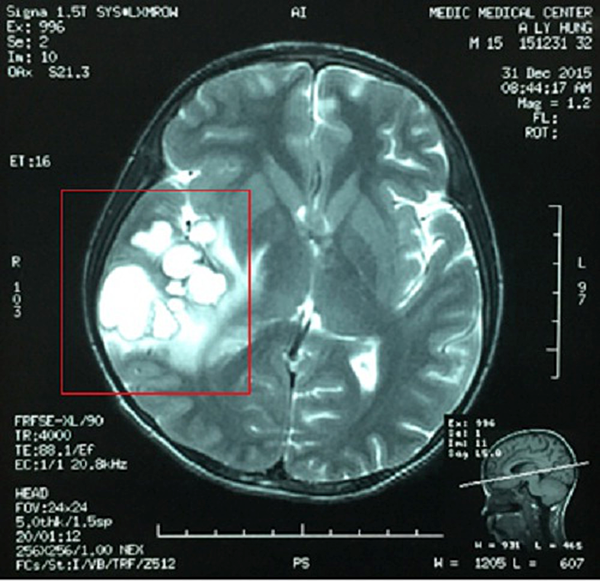 Một hình ảnh chụp về tổ sán trong não bệnh nhân. Ảnh do bác sĩ Đức cung cấp.