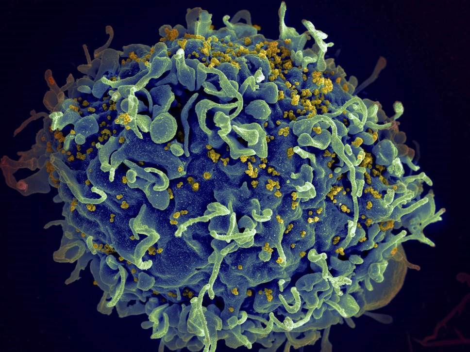 HIV (màu vàng) tấn công các tế bào miễn dịch của con người (màu xanh) và có thể được ức chế bằng thuốc kháng retrovirus, nhưng trước đây người ta cho rằng không có thuốc chữa bệnh. Ảnh: AP