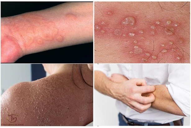 Bệnh chàm - Eczema: Nguyên nhân, triệu chứng và cách đánh bay ngứa