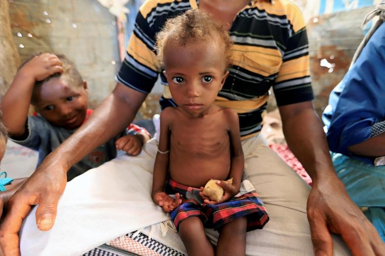 Bé Hanaa Ahmad Ali Bahr  bị suy dinh dưỡng ngồi trên đùi của cha mình ở một thị trấn tồi tàn ở Hodeidah, Yemen. Ảnh Reuters.