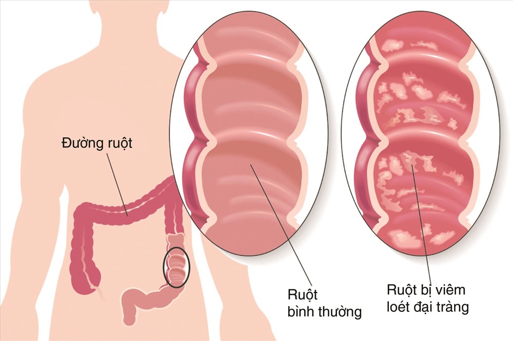 Bệnh viêm đại tràng ảnh hưởng xấu tới sức khỏe con người