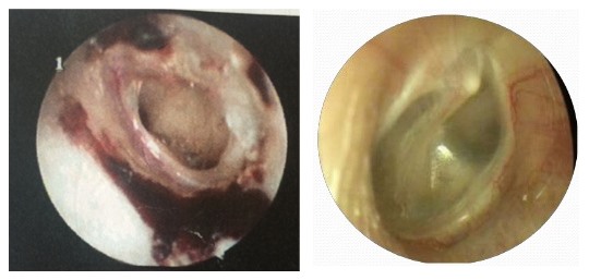 Hình ảnh màng nhĩ bị tổn thương của người bệnh (Hình trái) và hình ảnh màng nhĩ bình thường (Hình phải)