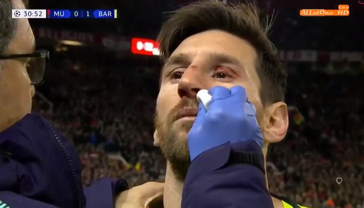 Messi “vỡ mũi” sau pha va chạm với Chris Smalling. 