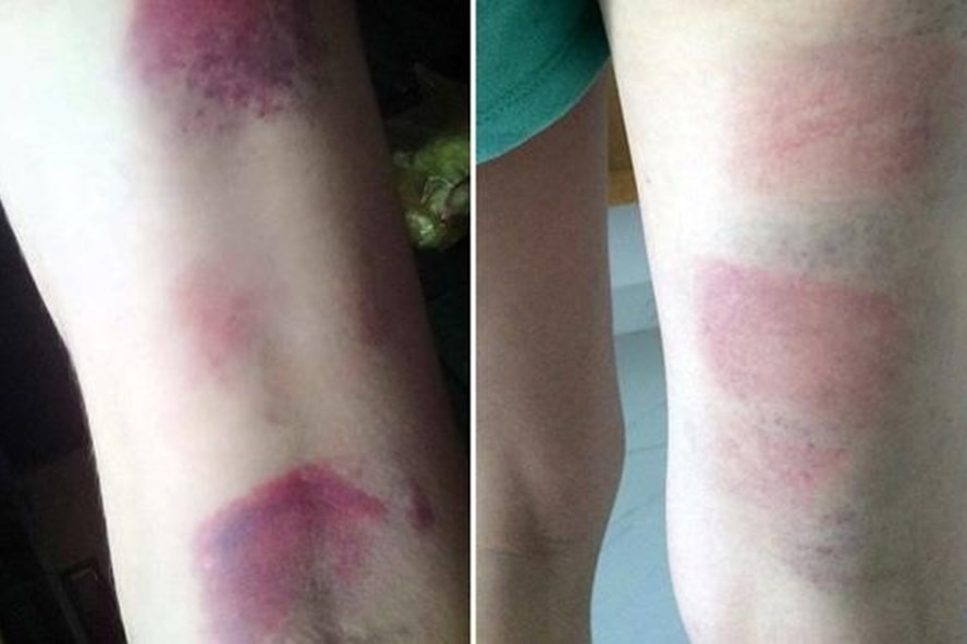  Hình ảnh em học sinh bị cô giáo đánh bầm tím, được phụ huynh chụp đưa lên mạng xã hội và tố cáo đến nhà trường. 