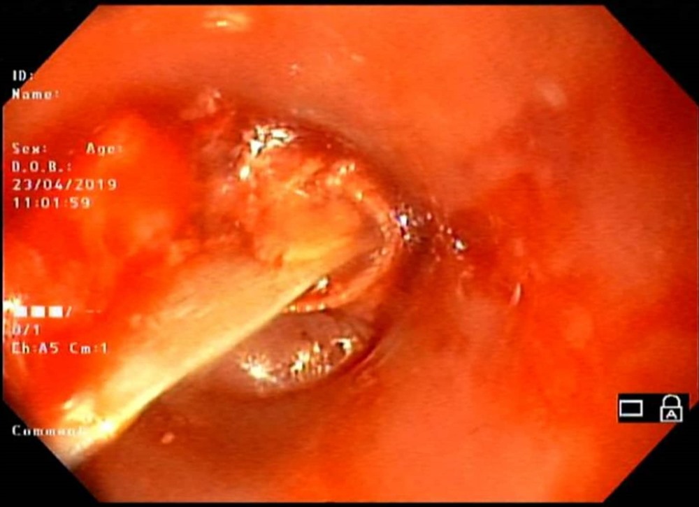Hình ảnh xương mang cá trong thực quản của bệnh nhân. Ảnh: BSCC