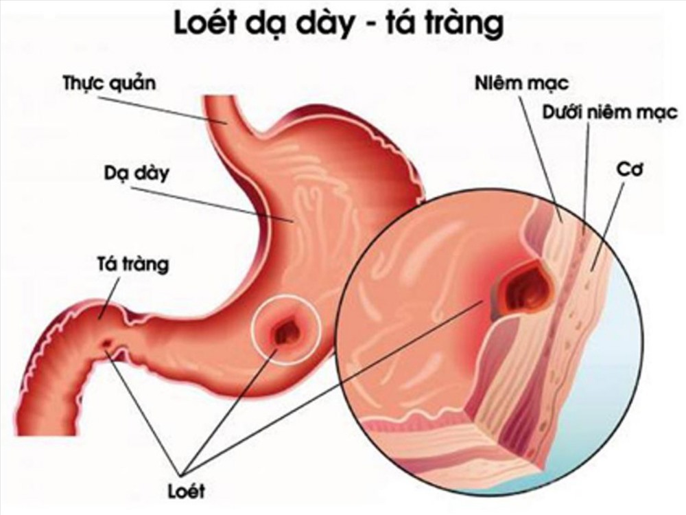 Bệnh loét dạ dày từng khiến \