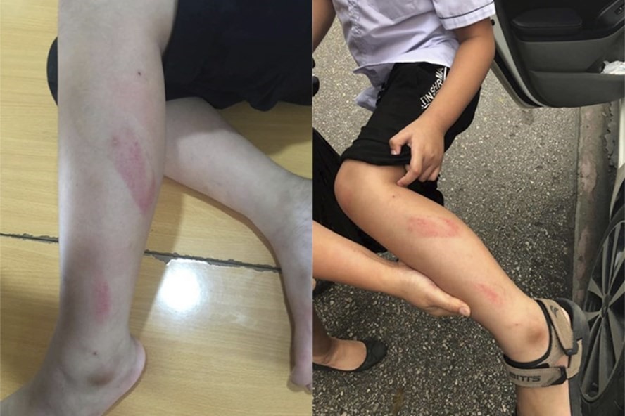 Học sinh Đ. bị cô giáo đánh vào chân trong giờ kiểm tra học kỳ. Ảnh: Minh Khang. 