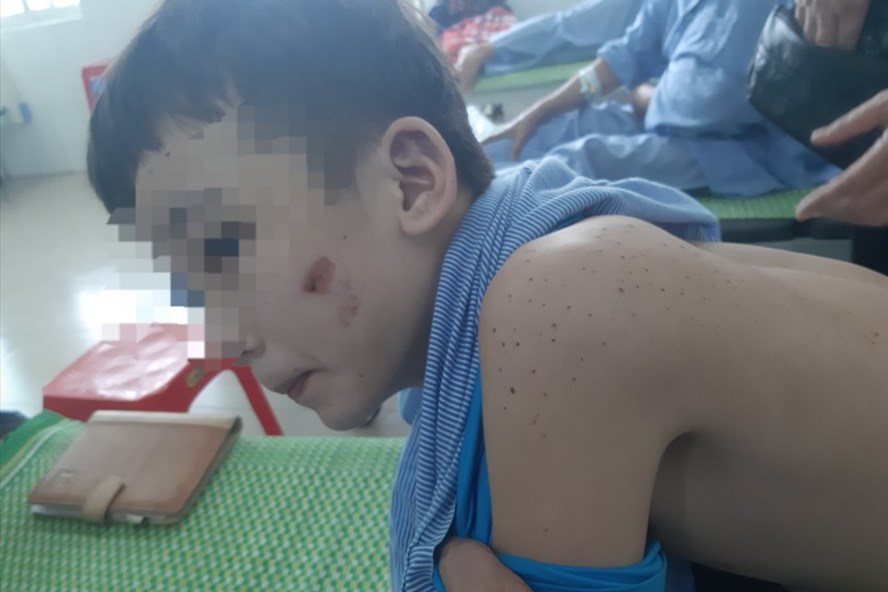 Vụ nhân viên quán bánh xèo bị tra tấn dã man