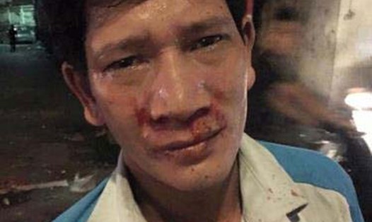 Anh Nguyễn Văn Sinh khuôn mặt bê bết máu do bị hành hung.