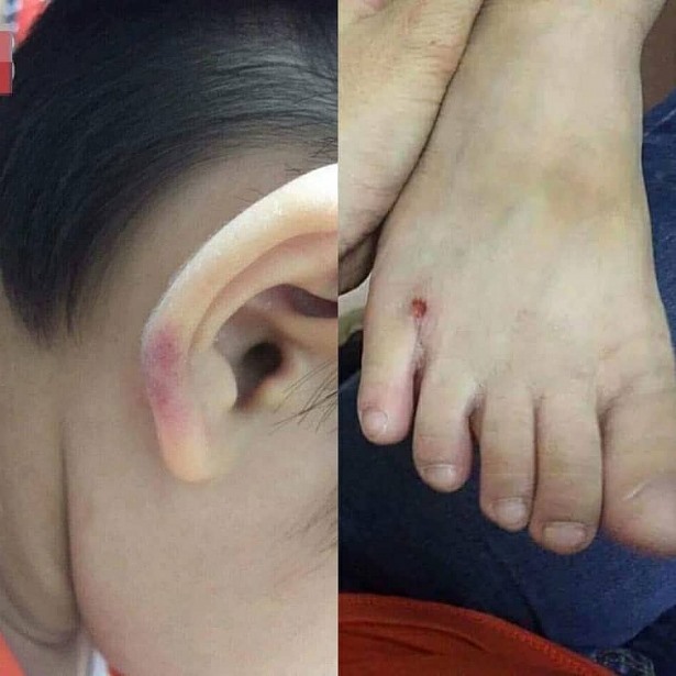 Những vết thâm tím phần mềm của cháu bé được cho là do bị đánh. Ảnh: NVCC
