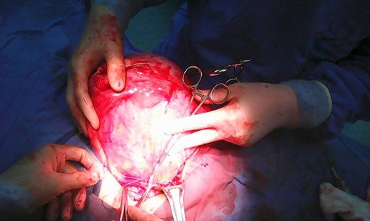 Khối u xơ tử cung nặng 2,8kg vừa được cắt bỏ thành công, cứu sống nữ bệnh nhân. Ảnh:CĐ