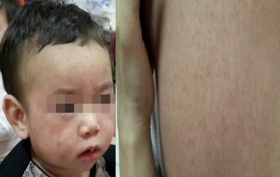 Biểu hiện phát ban khi trẻ mắc bệnh sởi