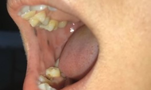 Các nốt sắc tố sậm màu trong miệng bệnh nhân