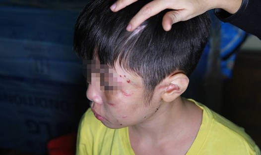 Những vết thương khắp người của bé trai 10 tuổi bị bố và mẹ kế 
bạo hành ở Nghĩa Đô (Cầu giấy, Hà Nội). Ảnh: Ngô Cường
