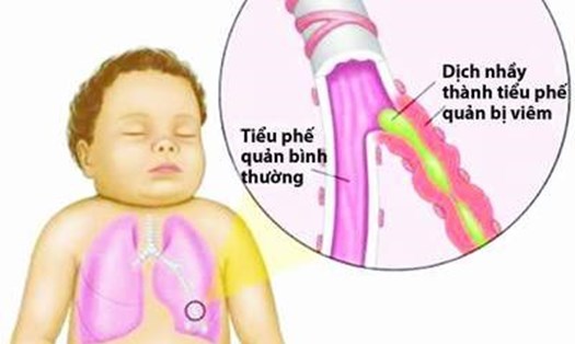 Mùa lạnh cần cẩn thận với bệnh đường hô hấp ở trẻ nhỏ (Ảnh minh họa)