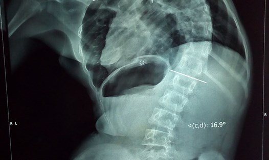 Kết quả chụp MRI cho thấy, cột sống bé M. bị vẹo 111 độ, giống hình chữ S, bị rỗng tủy cổ