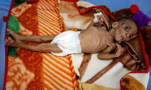 Bé Fatima Abdullah Hassan 1 tuổi bị suy dinh dưỡng nghiêm trọng, nằm trong một trung tâm điều trị ở thành phố cảng Hodeida ven Biển Đỏ, Yemen. Ảnh: Reuters