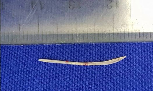 Chiếc xương cá dài 2,5 cm được lấy ra 