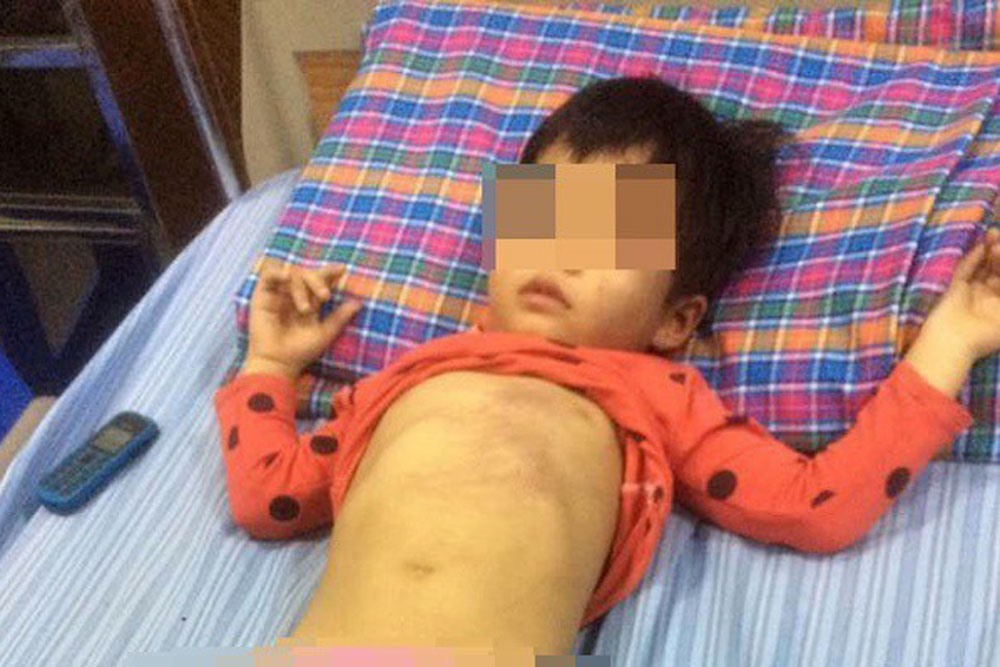 Bé 4 tuổi bị đa chấn thương. Cô giáo nói do bị bạn đánh, còn gia đình nghi ngờ bị cô giáo bạo hành.