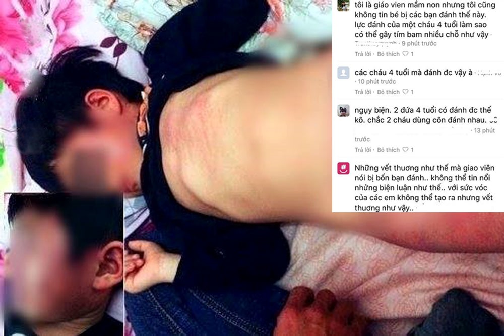 Nhiều người không tin việc bé 4 tuổi bị bầm tím khắp người là do bị bạn học đánh.