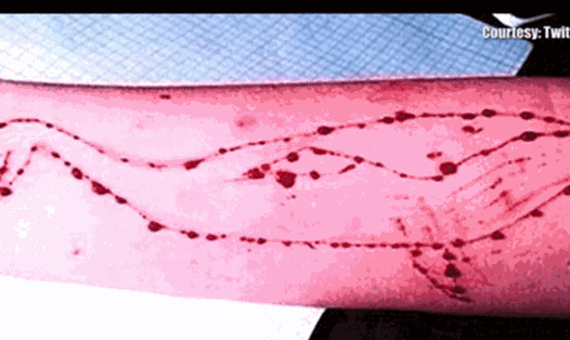 Hình cá voi xanh được rạch trên tay thanh niên nước ngoài.