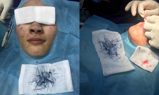 Hàng trăm sợi chỉ được gắp ra từ mũi bệnh nhân.

