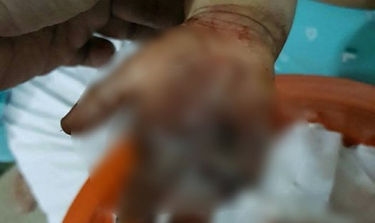 Bàn tay phải bị đứt, ngón tay bị dập nát do nghịch xích xe máy đang hoạt động của bệnh nhi 2 tuổi