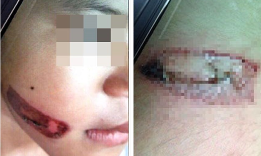 Những vết thương trên người bé gái 7 tuổi ở Kiên Giang.