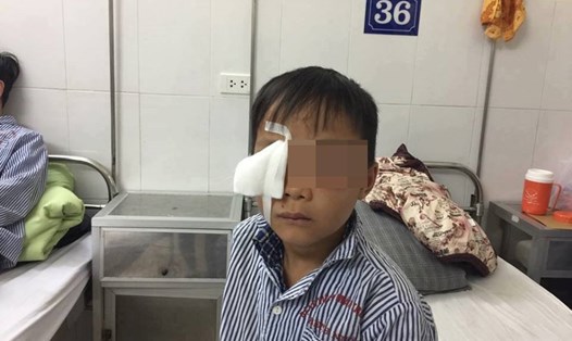 Bé Quang bị chó 20 kg cắn gây chấn thương nghiêm trọng ở mắt (Ảnh: PV)