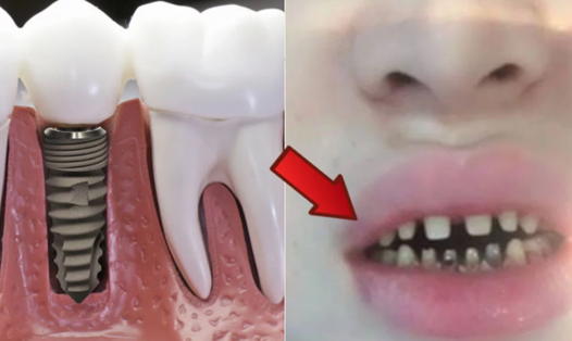 Làm răng sứ không đảm bảo: tiền mất, tật mang. Hình ảnh nạn nhân tố cơ sở làm đẹp trên mạng