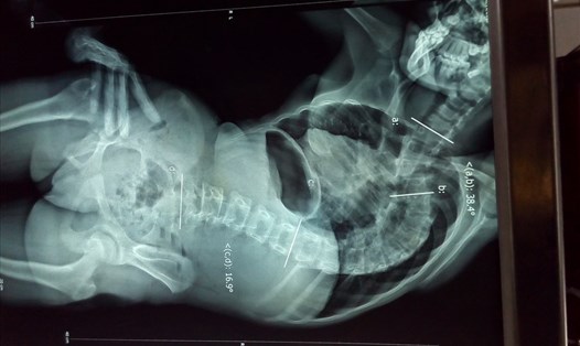 Kết quả chụp MRI cho thấy, cột sống bé M. bị vẹo 111 độ, giống hình chữ S, bị rỗng tủy cổ.