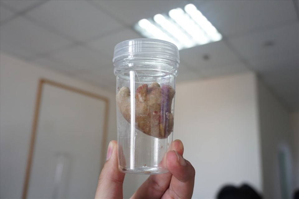 Viên sỏi thận của bệnh nhân Viên sỏi thận của bệnh nhân