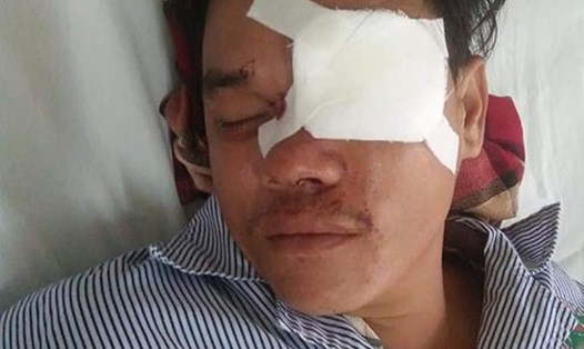 Hình ảnh anh Lê Tấn Sinh sau khi bị Bé Tư đâm mù mắt. Ảnh: C.A