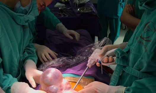 Các bác sĩ Bệnh viện Sản Nhi Quảng Ninh tiến hành phẫu thuật khối u