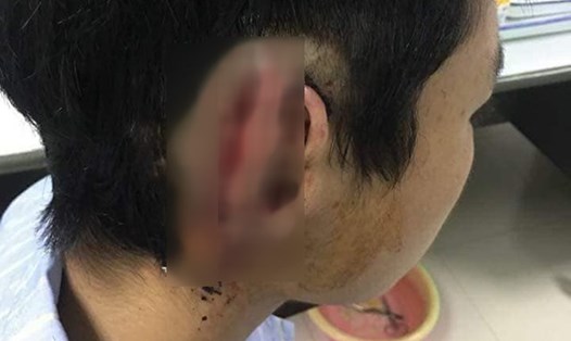 Bệnh nhân T được tái tạo vành tai sau ca tai nạn hy hữu