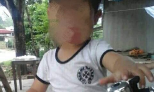 Cháu H.T.A. (5 tuổi) bị tử vong sau khi cắt Amidan tại Bệnh viện Đa khoa tỉnh Yên Bái (Ảnh: Dân trí)