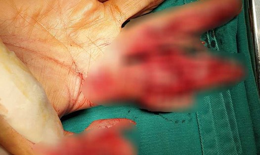 Các ngón tay dập nát, biến dạng hoàn toàn Ảnh: benhvienhungvuong.org