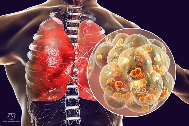 Liệu viêm phổi thùy có thể chữa khỏi hoàn toàn không?
