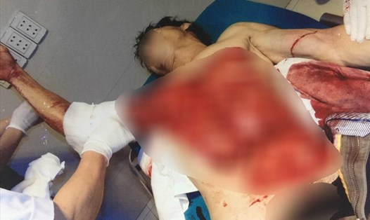 Nạn nhân bị lột sạch da ngực, bụng khi nhập viện Ảnh:  benhvienhungvuong.org