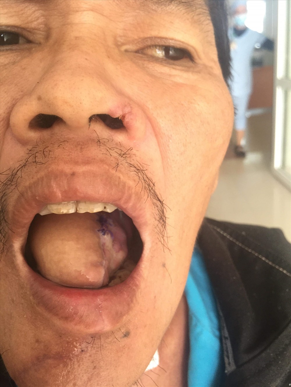 Một bệnh nhân mắc ung thư lưỡi lan rộng được phẫu thuật thành công